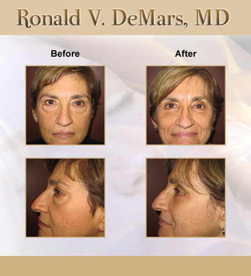 lower-blepharoplasty-eyelid-surgery-dr-demars